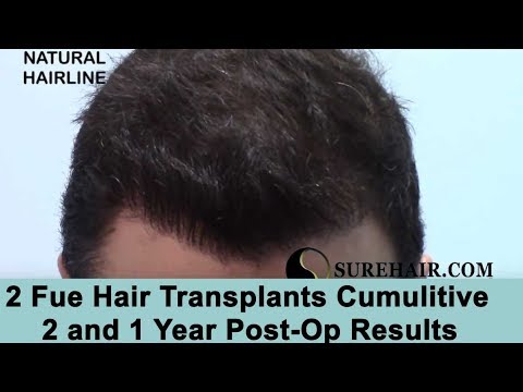 Norwood 3 and Crown Hair Transplant Results From 2 FUE Hair Transplant