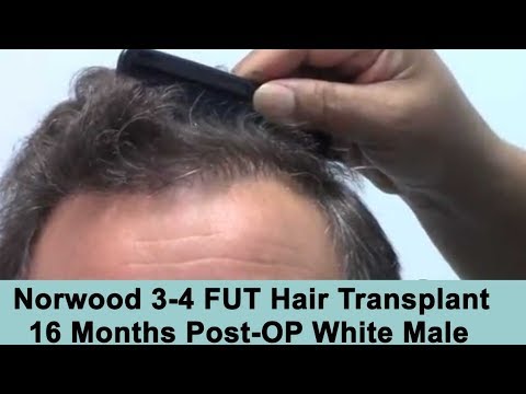 16 Months Post-Op FUT Hair Transplant
