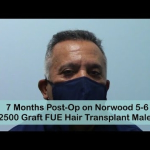FUE 7 Months Male Post-Op-Norwood 5-6