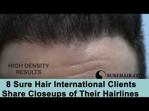 Hairline Close Ups