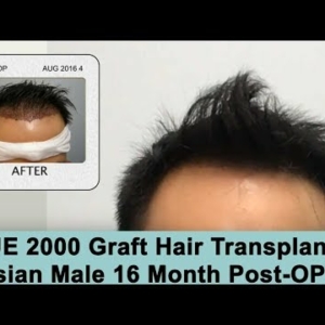 Norwood 3 FUE 2000 Grafts Asian Male - 16 Month Post-OP