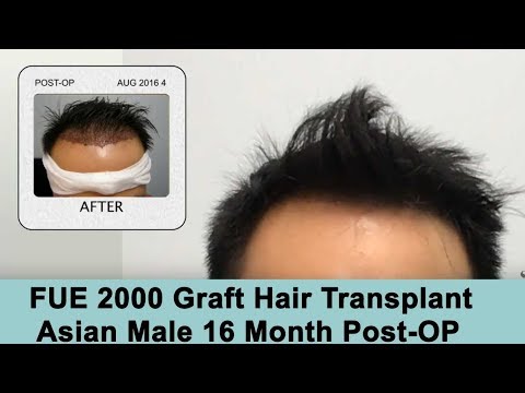 Norwood 3 FUE 2000 Grafts Asian Male - 16 Month Post-OP
