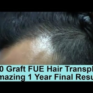 Norwood 3 Pattern 2000 Graft FUE Hair Transplant 1 Year Final Result