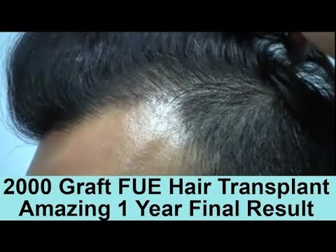 Norwood 3 Pattern 2000 Graft FUE Hair Transplant 1 Year Final Result