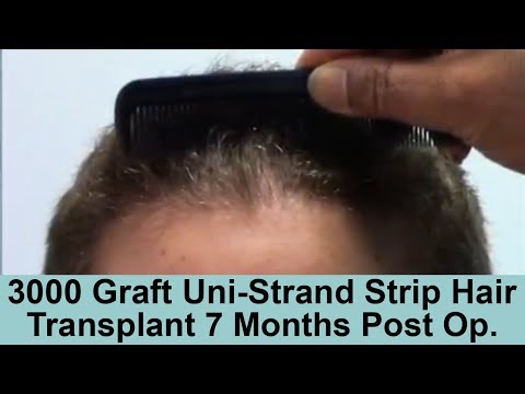 Norwood 4 Caucasian Male 3000 Graft FUT Hair Transplant