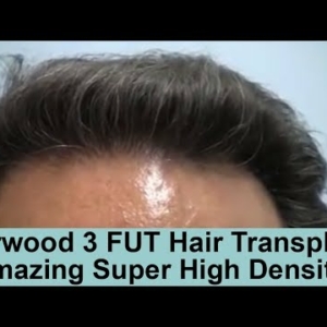 Caucasian Male Norwood 3 FUT Strip Hair Transplant With High Density Results