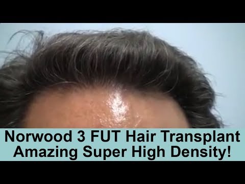 Caucasian Male Norwood 3 FUT Strip Hair Transplant With High Density Results