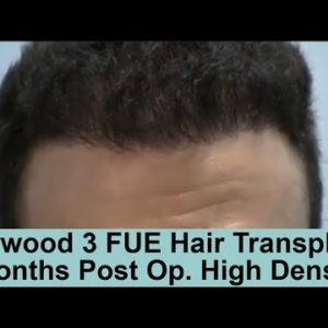 Caucasian Male 8 Month Post Op. 2000 Graft FUE Hair Transplant - Norwood 3 pattern