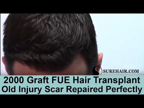 Hair Transplant - Old Injury Scar Repair on Norwood 3 Caucasian Male 2000 Graft FUE