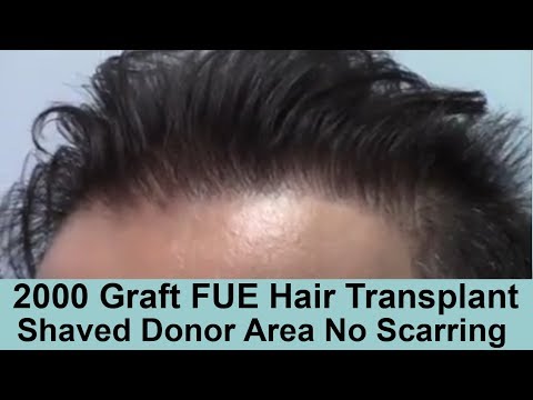 Norwood 3 2000 Graft FUE Hair Transplant  South European