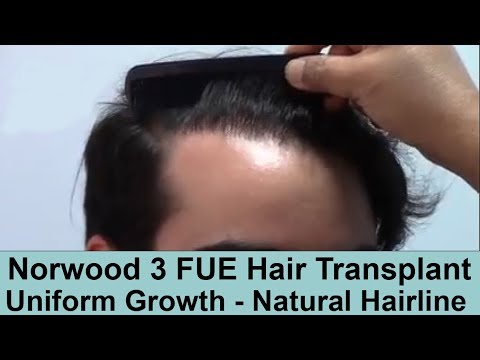 Norwood 3 Hair loss pattern - FUE Hair Transplant