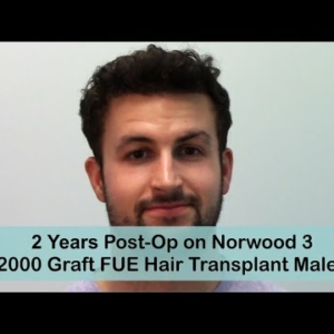 FUE 2 Year Post-Op Norwood 3 with 2500 Grafts