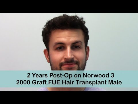 FUE 2 Year Post-Op Norwood 3 with 2500 Grafts