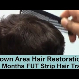 Crown area hair restoration 7 Months Post-Op FUT Hair Transplant