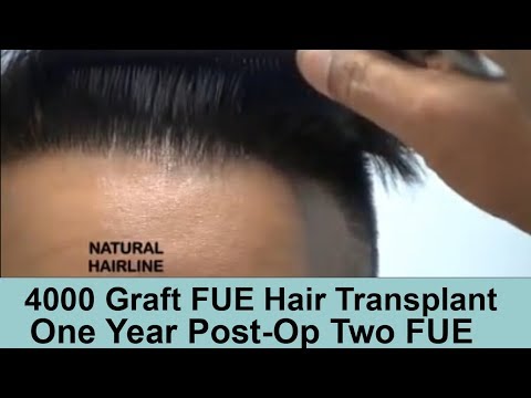 Two FUE Hair Transplant procedures 1 year post-op