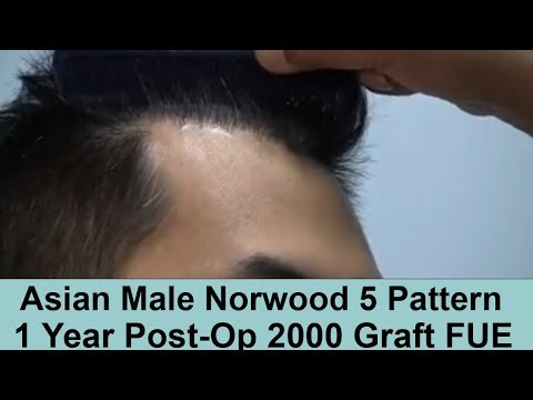 Asian Male Norwood 5 Pattern - 1 Year Post-Op 2000 Graft FUE