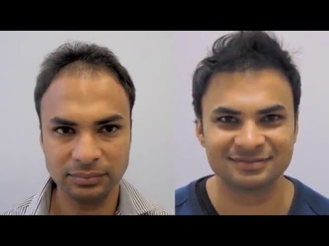 East Indian Male 3300 FUT Hair Transplant