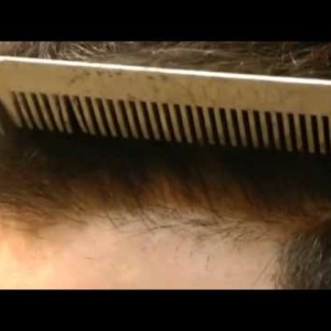 2000 FUE Hairline hair Transplant  – Hairline (High Density)