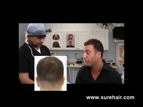 Before and After Artas Hair Transplant Client Review
