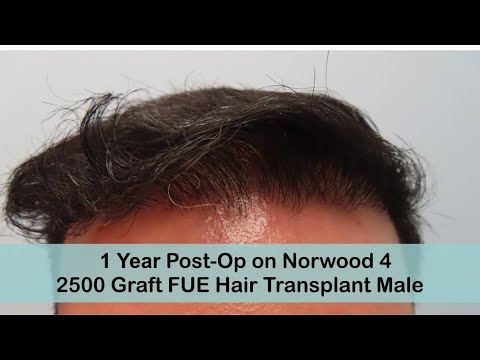 FUE 1 Year Post-Op Norwood 4 with 2500 Grafts