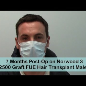 FUE 7 Months Post-Op Norwood 3 with 2500 Grafts