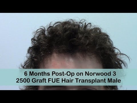 FUE 6 Months Post-Op Norwood 3 with 2500 Grafts