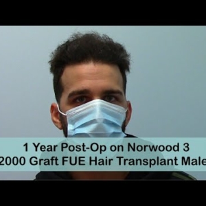 FUE 1 Year Post-Op Norwood 3 with 2500 Grafts