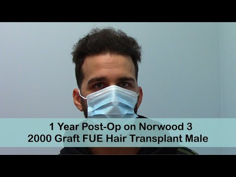 FUE 1 Year Post-Op Norwood 3 with 2500 Grafts