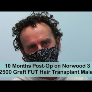 FUT 10 Months Post-Op Norwood 3 with 2500 Grafts