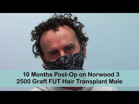 FUT 10 Months Post-Op Norwood 3 with 2500 Grafts