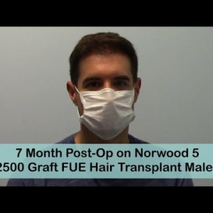 FUE 7 Months Post-Op Norwood 5 with 2500 Grafts