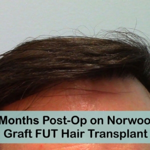 9 Months Post-Op FUT Hair Transplant