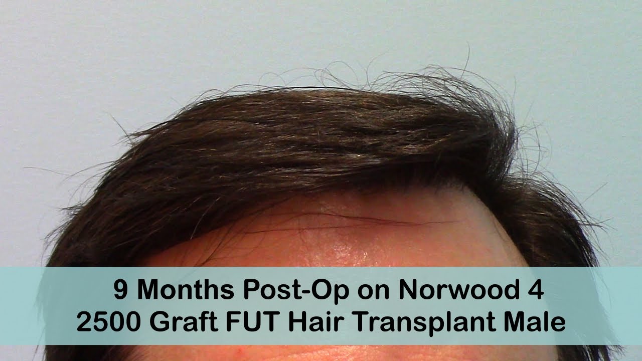 9 Months Post-Op FUT Hair Transplant