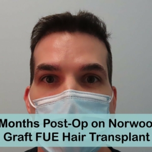 FUE Hair Transplant 8 Month Results Norwood 3 Hair loss pattern