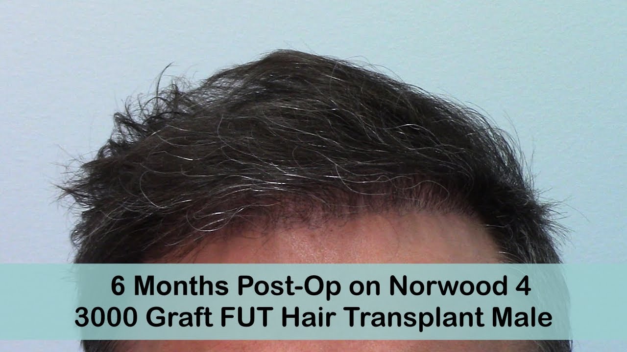 FUT 6 Months Male Post-Op Norwood 4