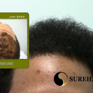 FUT Hair Transplant 1 Year Male Post-Op-Norwood 2