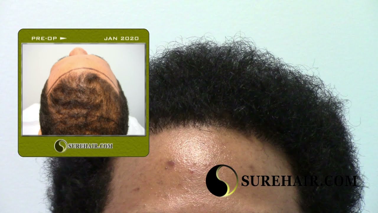 FUT Hair Transplant 1 Year Male Post-Op-Norwood 2