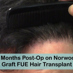FUE 10 Month Post-Op Norwood 3 with 2500 Grafts