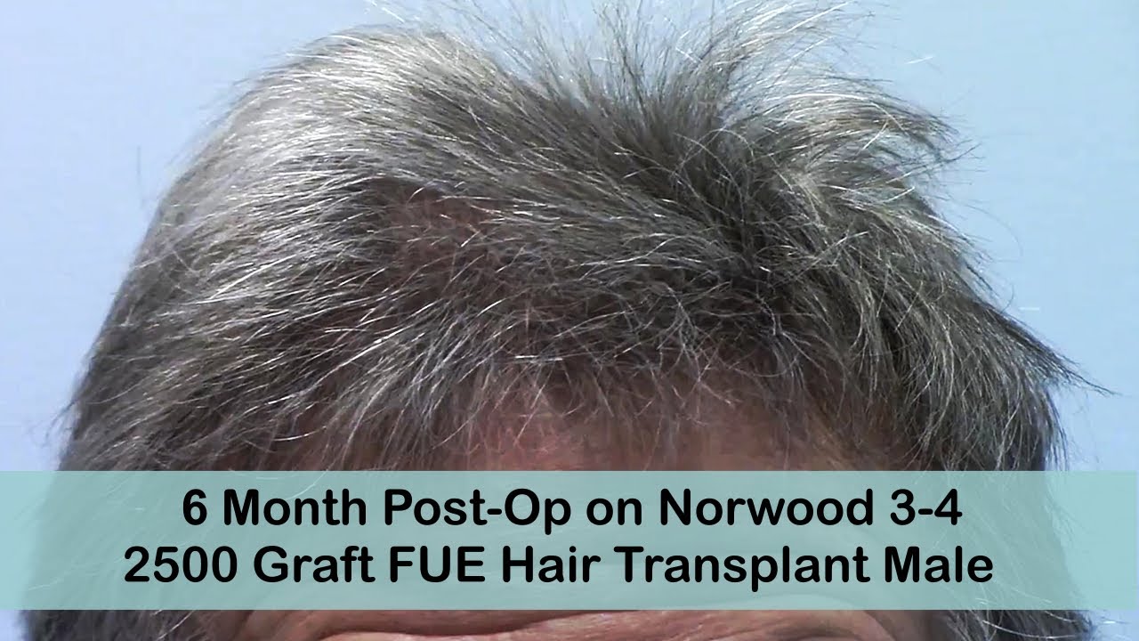 FUE 6 Months Post-Op Norwood 3-4 with 2500 Grafts