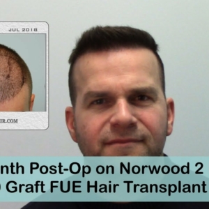 FUE Hair Transplant 2000 Grafts AT 18 Months Post-Op