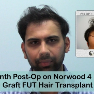 14 Month Post-Op On Norwood 4 3000 Graft FUT Hair Transplant