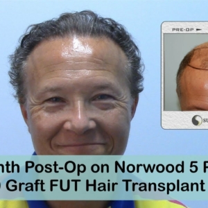 8 Month Post-OP FUT 3000 Grafts Hair Transplant - Norwood 5 Male