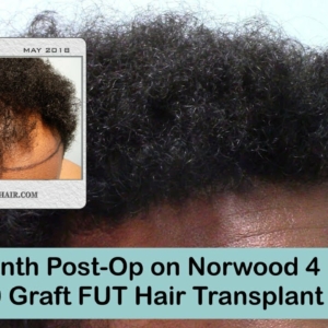 3000 Graft FUT Hair Transplant 13 Month Post-Op Norwood 4 Pattern