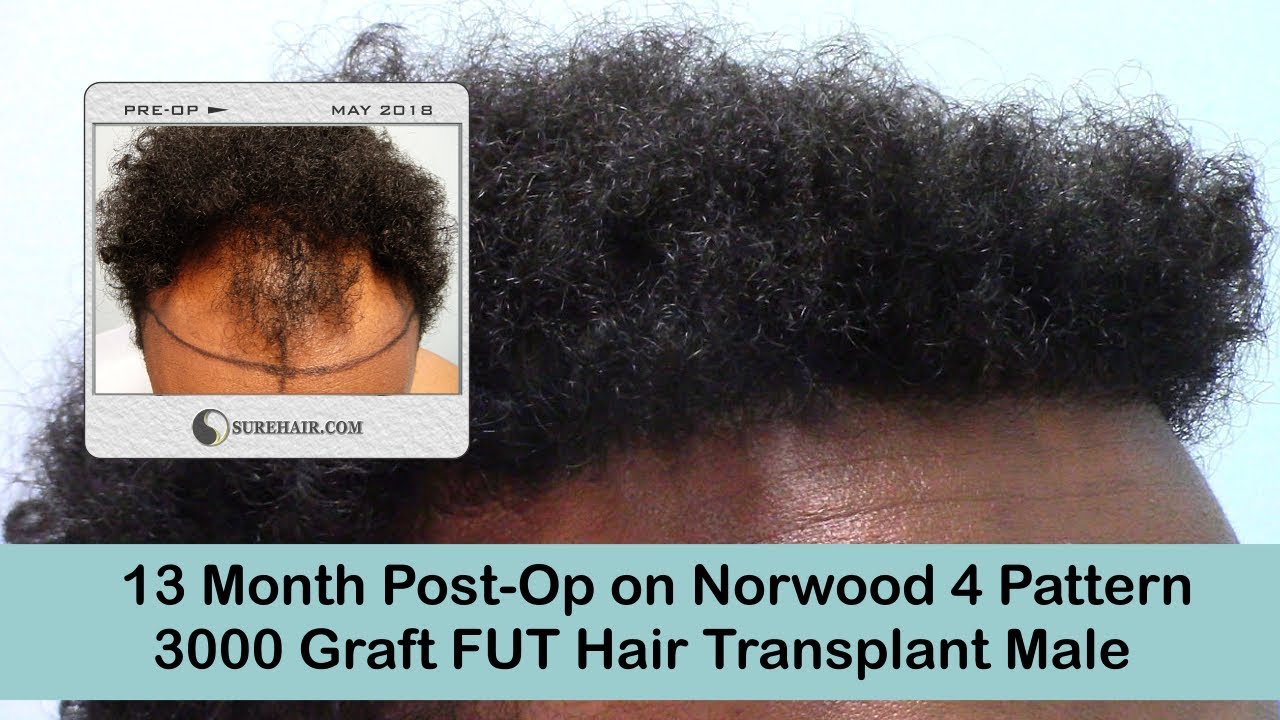 3000 Graft FUT Hair Transplant 13 Month Post-Op Norwood 4 Pattern
