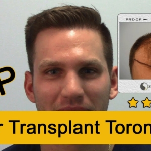 2500 Graft FUE Hair Transplant 1 Year Post-Op
