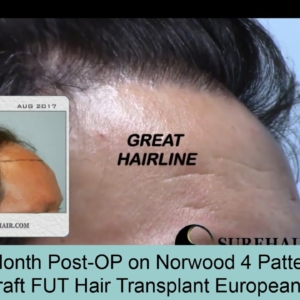18 Month Post-Op 3000 Graft FUT Hair Transplant on Norwood 4 Pattern