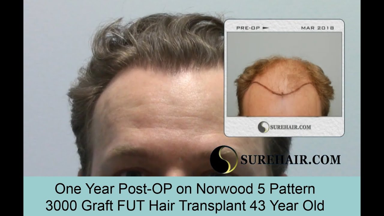 One Year Post-Op 3000 Graft FUT Hair Transplant on Norwood 5 Pattern