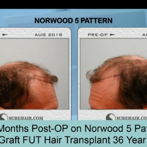 8 Month Post-Op 2500 Graft FUT Hair Transplant on Norwood 5 Pattern