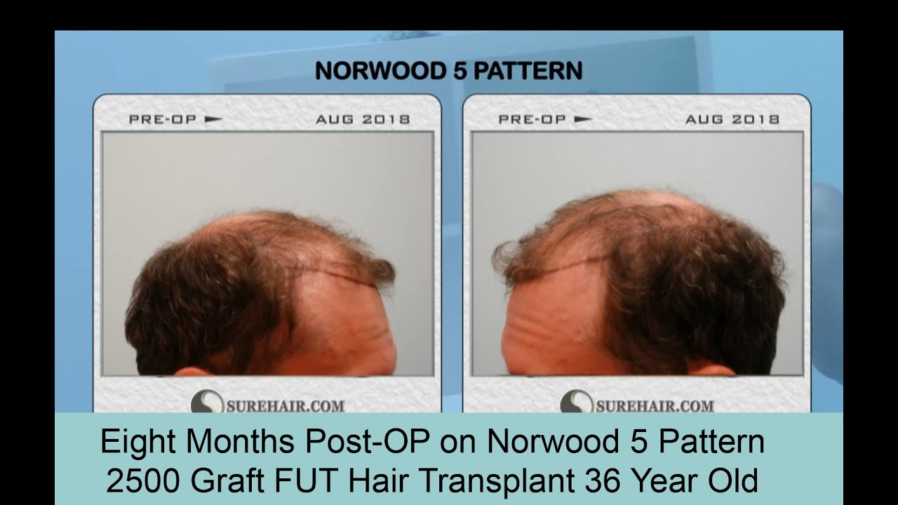 8 Month Post-Op 2500 Graft FUT Hair Transplant on Norwood 5 Pattern