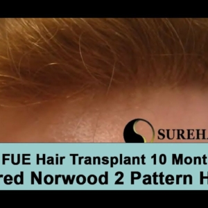 10 Month Post-OP 2000 Graft FUE Hair Transplant on Red Haired Norwood 2 Hair loss Pattern